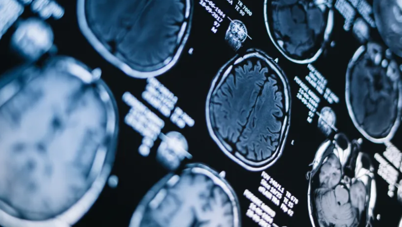 17-trial-review-questions-alzheimers-breakthrough-drugs-over-minimal-benefit-and-safety-risks