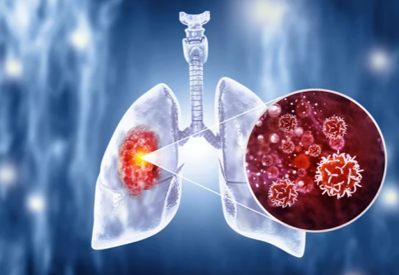 50-of-lung-cancer-cases-are-detected-during-advanced-stages