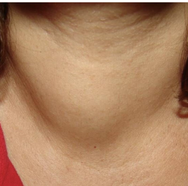 Thyroid Nodule vs. Neck Lump: When Should You Be Concerned? decoding=
