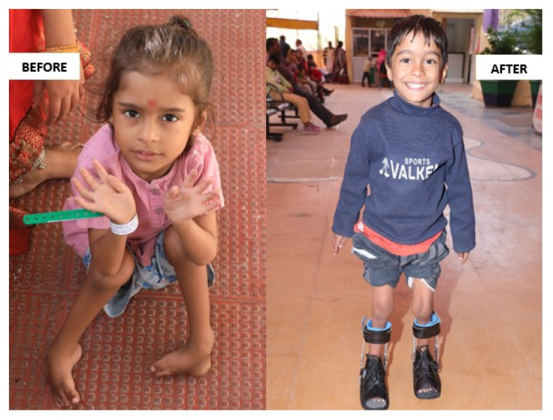 first-steps-of-hope-six-year-old-from-bihar-walks-after-successful-treatment-for-clubfoot