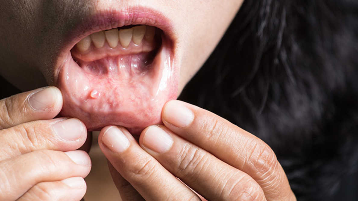 New study may help develop therapeutics for tongue cancer decoding=