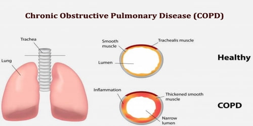 50-60-smokers-suffer-from-copd