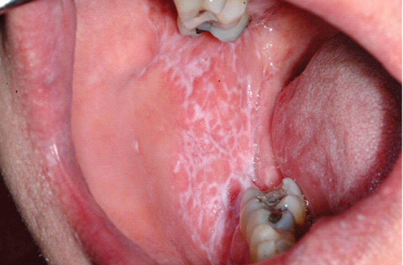 Quantity and texture affect the oral cavity, leads to oral diseases decoding=