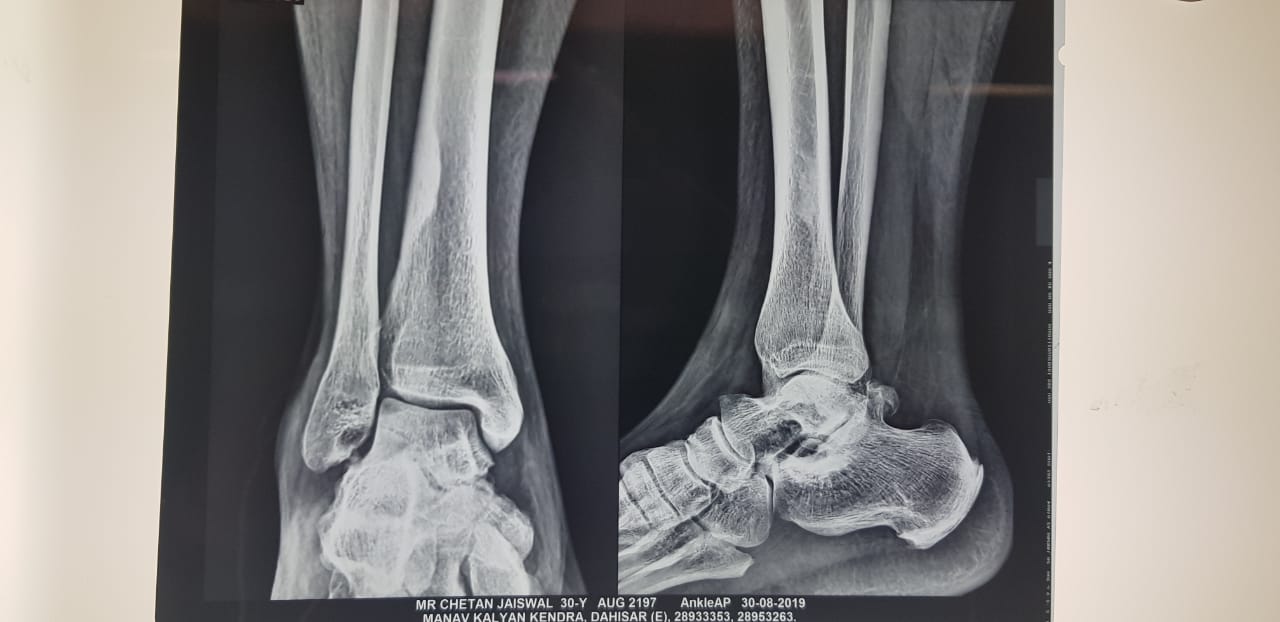 Wockhardt Hospital, Mira Road Successfully Treated A 30-year-old Man Battling Ankle Pain For 8 Years decoding=