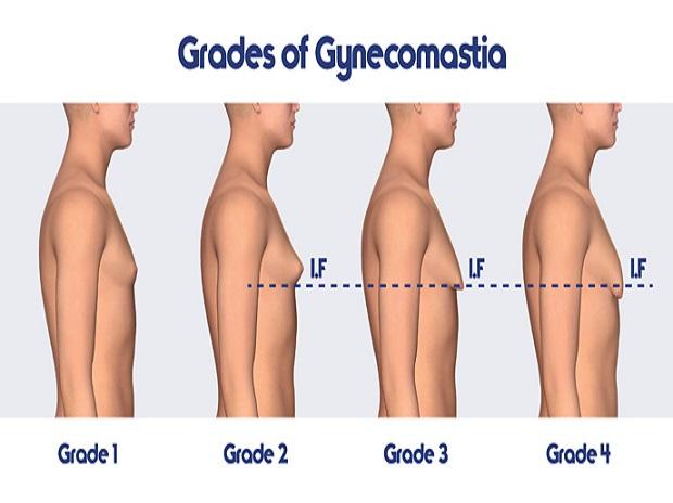 male-breast-reduction-gynecomastia-correction-can-be-done-via-keyhole-surgery