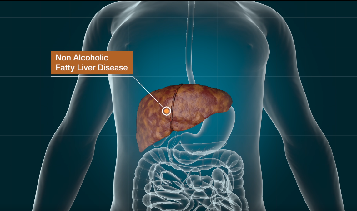 Modified Parkinson’s Drug Shows Potential in Treating Nonalcoholic Fatty Liver Disease decoding=
