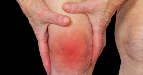 Joint pain, swelling, stiffness and deformity-Arthritis decoding=
