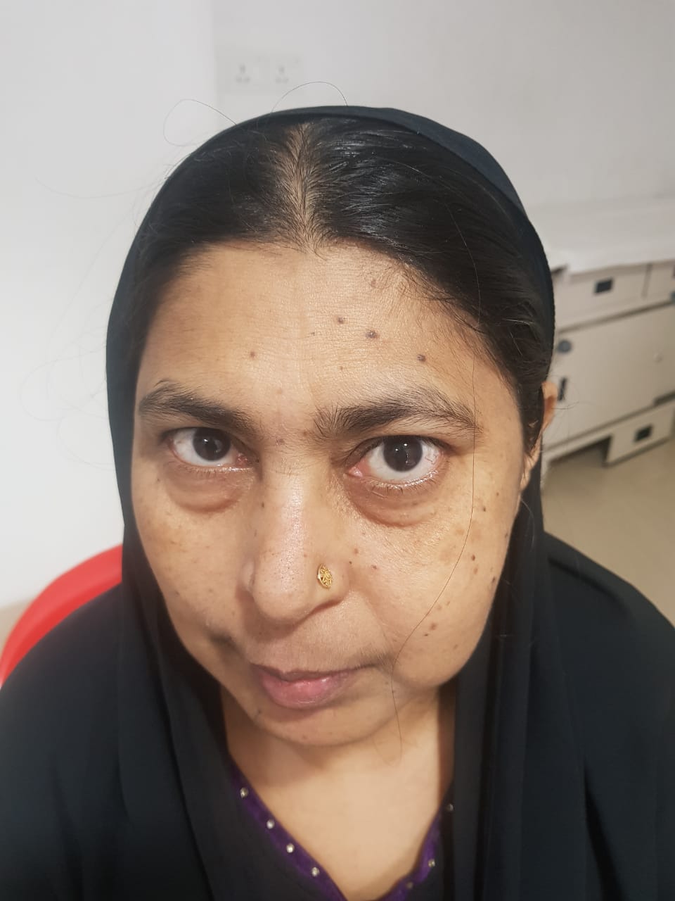55-year-old-woman-with-rare-maxillary-nerve-schwannoma-successfully-treated-by-the-doctors