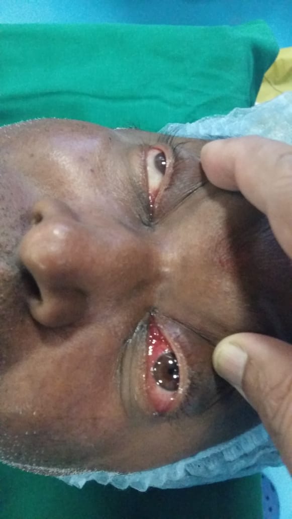 kohinoor-hospital-successfully-removes-1-5-cm-tumour-from-47-year-old-mans-eye-via-nose