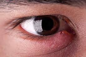 That early morning swollen eyelid could be due to an infection decoding=